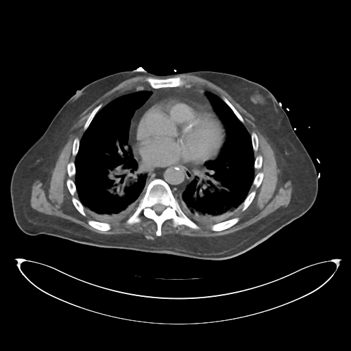 File:Obstructive pyelonephritis (Radiopaedia 46411-50844 Axial non-contrast 2).png