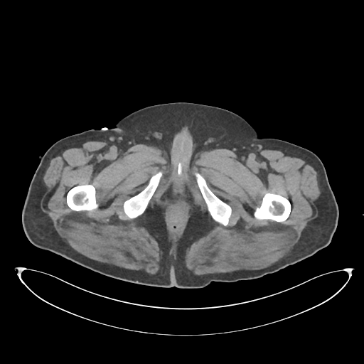File:Obstructive pyelonephritis (Radiopaedia 46411-50844 Axial non-contrast 86).png