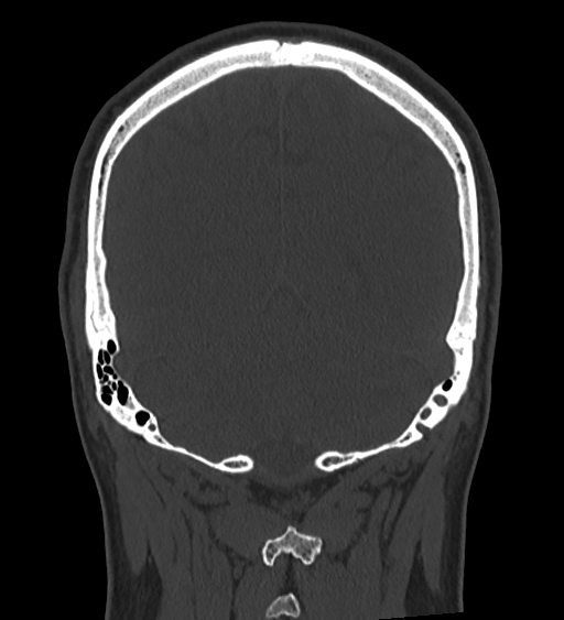 Occipital spur and Currarino type A atlas anomaly (Radiopaedia 87027-103285 Coronal bone window 110).jpg