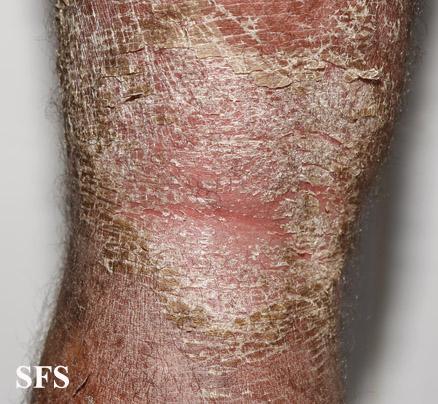 File:Psoriasis (Dermatology Atlas 74).jpg