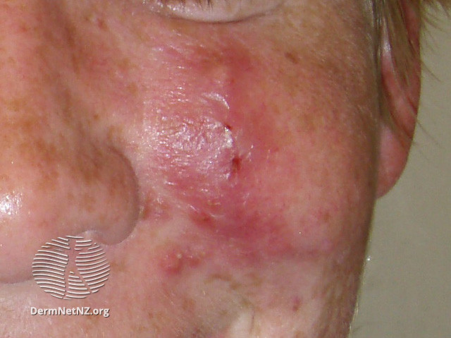 Rosacea (DermNet NZ acne-red-face-3602).jpg