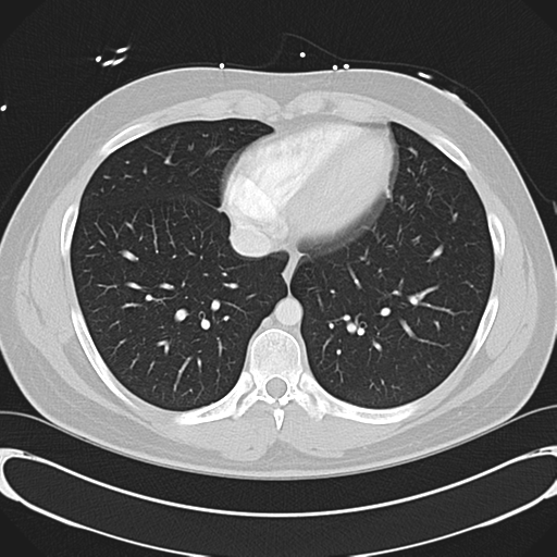 File:'Bovine' aortic arch (Radiopaedia 33554-34637 Axial lung window 44).png