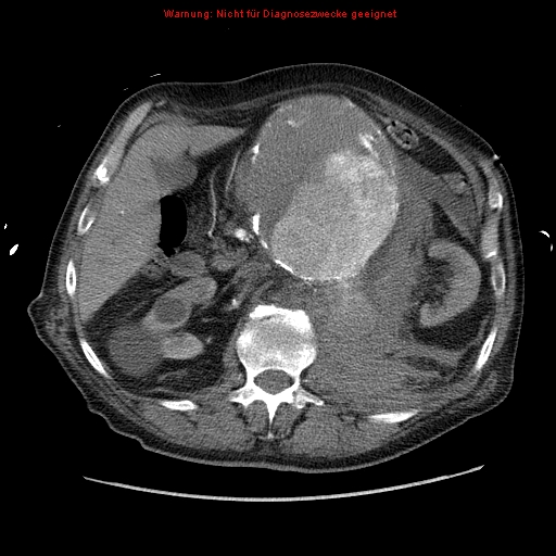 Abdominal aortic aneurysm- extremely large, ruptured (Radiopaedia 19882-19921 Axial C+ arterial phase 25).jpg