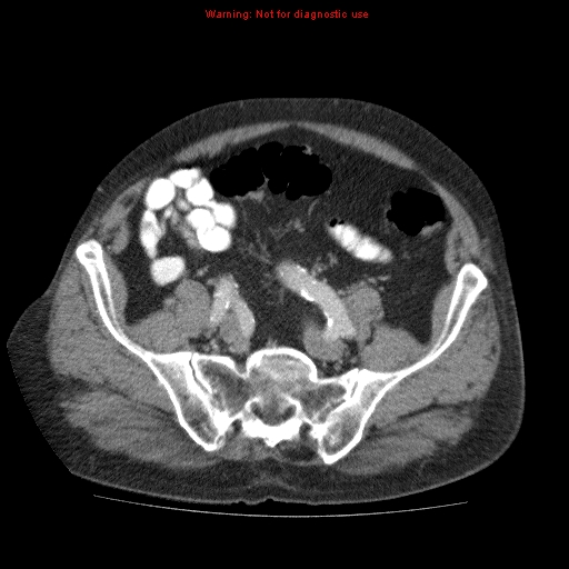 Abdominal aortic aneurysm (Radiopaedia 10122-10660 Axial C+ portal venous phase 60).jpg