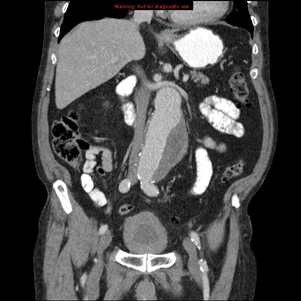 File:Abdominal aortic aneurysm (Radiopaedia 10122-10660 Coronal C+ portal venous phase 19).jpg