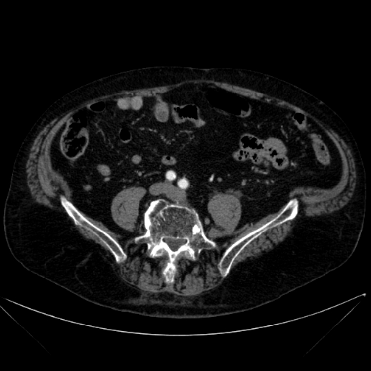 Abdominal aortic aneurysm (Radiopaedia 25855-26001 Axial C+ arterial phase 90).jpg