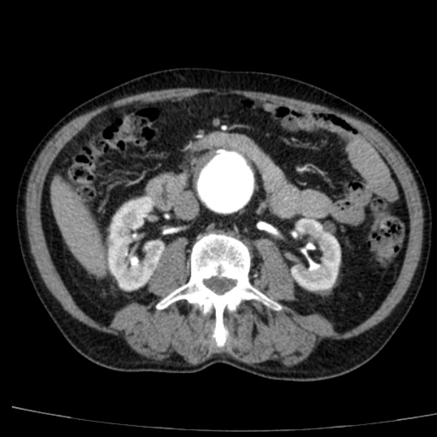 Abdominal aortic aneurysm (Radiopaedia 29248-29660 Axial C+ arterial phase 40).jpg