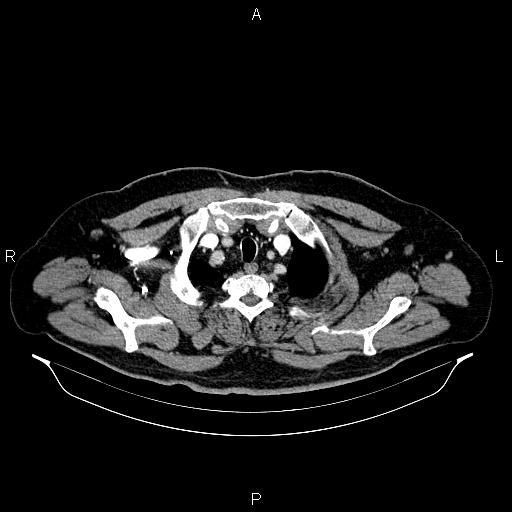 Abdominal aortic aneurysm (Radiopaedia 83094-97462 Axial renal cortical phase 10).jpg