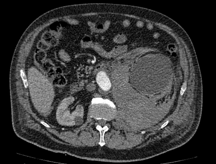 Abdominal aortic aneurysm rupture (Radiopaedia 54179-60362 Axial C+ arterial phase 30).jpg