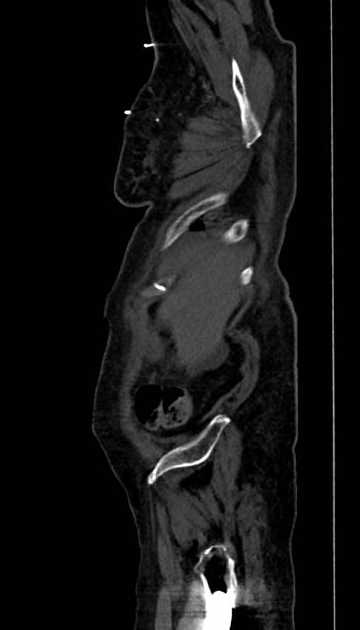 Abdominal aortic aneurysm with thrombus fissuration (Radiopaedia 73192-83919 Sagittal C+ arterial phase 132).jpg