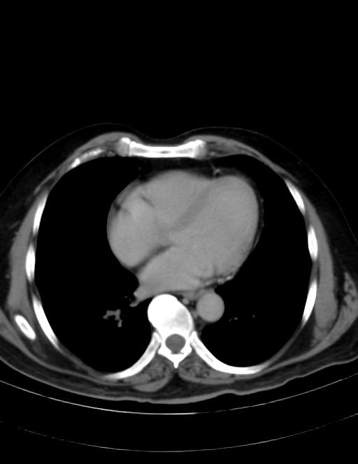 Abdominal lymphoma - with sandwich sign (Radiopaedia 53486-59492 Axial C+ portal venous phase 1).jpg