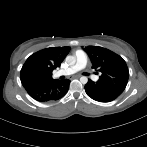 File:Abdominal multi-trauma - devascularised kidney and liver, spleen and pancreatic lacerations (Radiopaedia 34984-36486 Axial C+ arterial phase 38).png