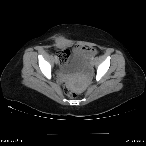 File:Abdominal wall endometriosis (Radiopaedia 25723-25885 Axial C+ portal venous phase 31).jpg