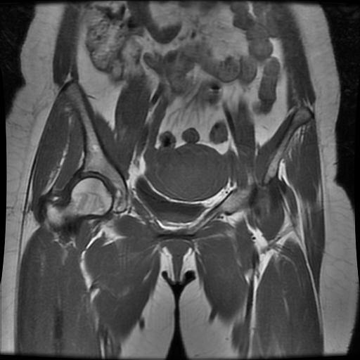 File:Abdominal wall endometriosis (Radiopaedia 83702-98847 Coronal T1 6).jpg