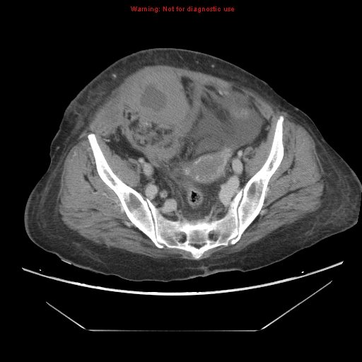 File:Abdominal wall hematoma (Radiopaedia 9427-10112 Axial C+ portal venous phase 87).jpg