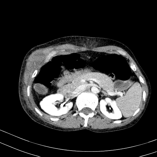 File:Abdominal wall hematoma with active bleeding (Radiopaedia 83915-99117 Axial C+ portal venous phase 14).jpg