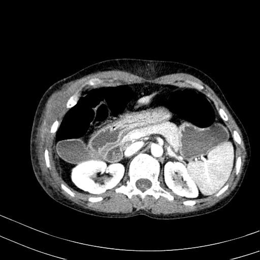 Abdominal wall hematoma with active bleeding (Radiopaedia 83915-99117 Axial renal cortical phase 10).jpg