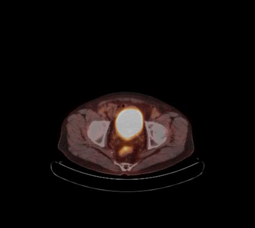 Abdominal wall metastasis from colorectal carcinoma (Radiopaedia 31016-31719 C 29).jpg