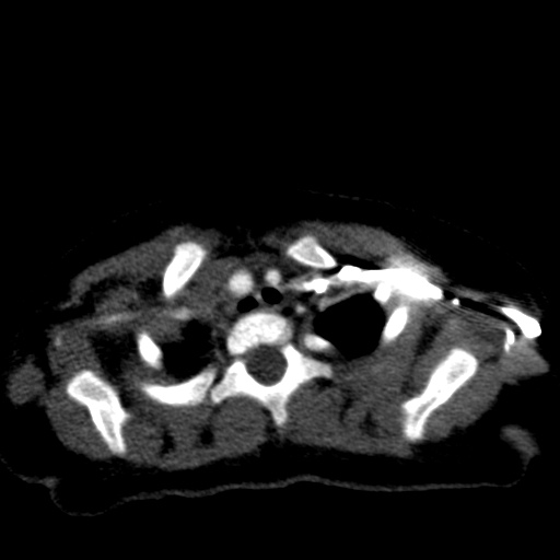 Aberrant left pulmonary artery (pulmonary sling) (Radiopaedia 42323-45435 Axial C+ CTPA 8).jpg