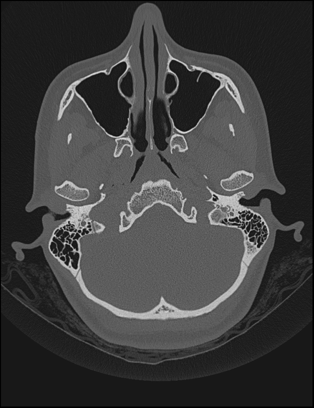 Aberrant right internal carotid artery (Radiopaedia 65191-74198 Axial non-contrast 25).jpg