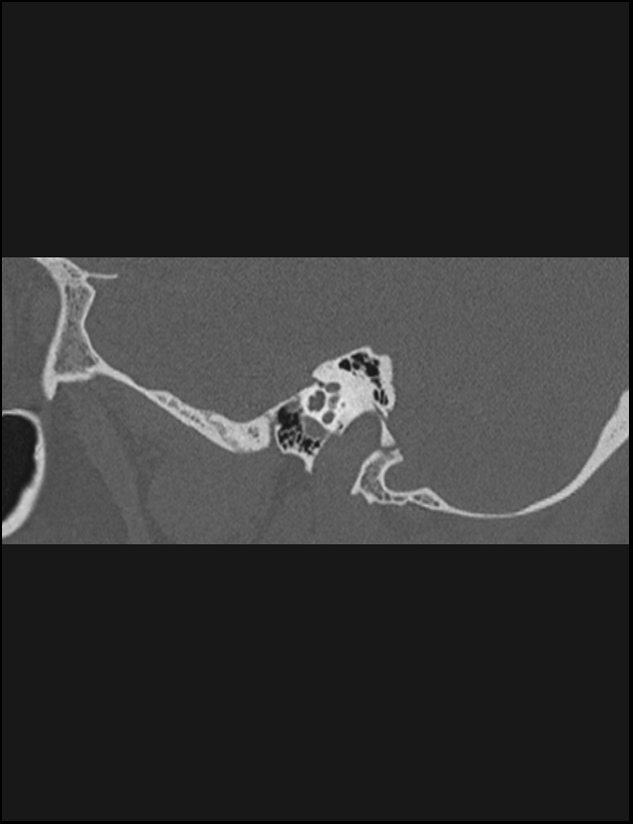 Aberrant right internal carotid artery (Radiopaedia 65191-74198 Sagittal non-contrast 54).jpg