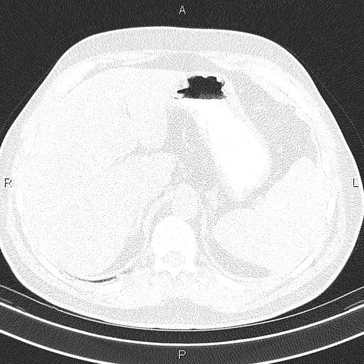Aberrant right subclavian artery (Radiopaedia 87093-103354 Axial lung window 112).jpg
