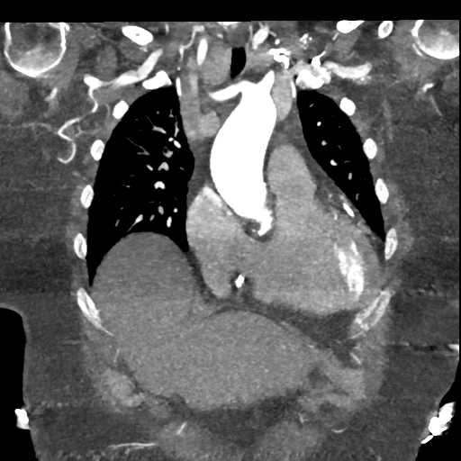 File:Aberrant right subclavian artery with Kommerell diverticulum (Radiopaedia 47982-52769 Coronal C+ arterial phase 21).png