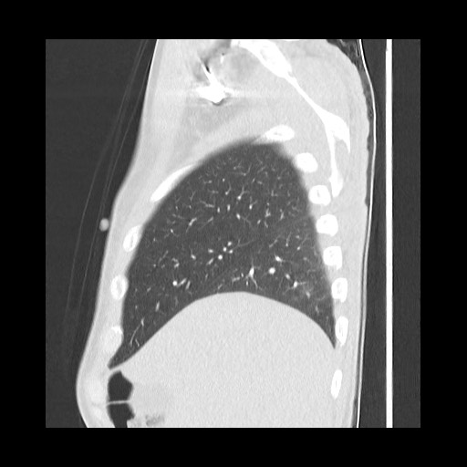 Accessory left horizontal fissure with lingular pneumonia (Radiopaedia 53763-59843 Sagittal lung window 15).jpg