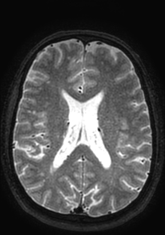 File:Accessory middle cerebral artery (Radiopaedia 73114-83828 Axial T2 35).jpg