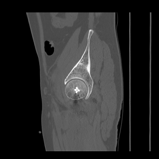 File:Acetabular and ilial fractures (Radiopaedia 59084-66378 Sagittal bone window 76).jpg