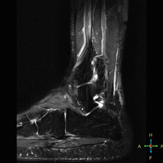 File:Achilles tendon complete tear (Radiopaedia 22834-22854 Sagittal STIR 4).jpg