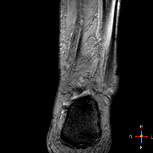 File:Achilles tendon complete tear (Radiopaedia 22834-22854 T2 fat sat 12).jpg