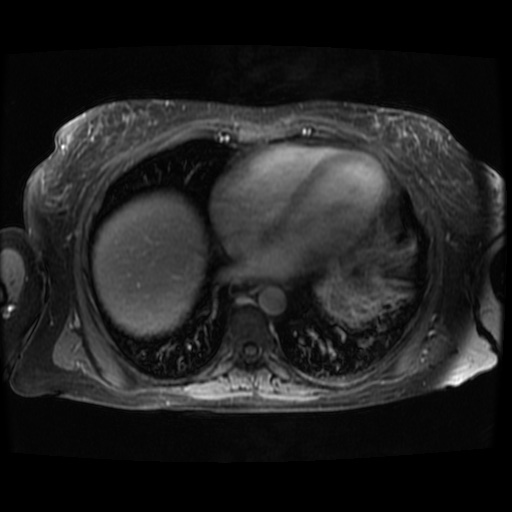 Acinar cell carcinoma of the pancreas (Radiopaedia 75442-86668 Axial T1 C+ fat sat 139).jpg