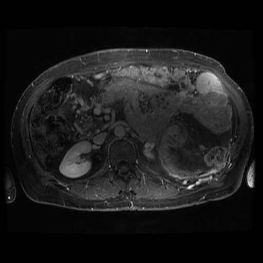 Acinar cell carcinoma of the pancreas (Radiopaedia 75442-86668 Axial T1 C+ fat sat 46).jpg