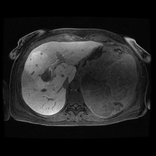 Acinar cell carcinoma of the pancreas (Radiopaedia 75442-86668 Axial late phase (~30 mins) 103).jpg
