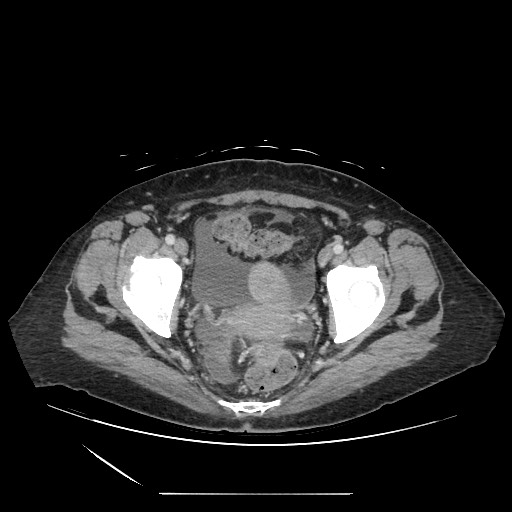 Acinar cell carcinoma of the pancreas (Radiopaedia 75442-86669 Axial C+ portal venous phase 133).jpg