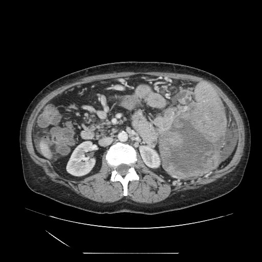 Acinar cell carcinoma of the pancreas (Radiopaedia 75442-86669 Axial C+ portal venous phase 61).jpg