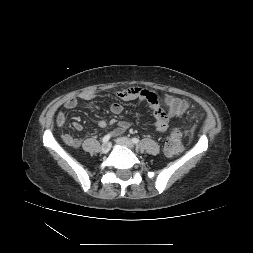 Acinar cell carcinoma of the pancreas (Radiopaedia 75442-86669 Axial C+ portal venous phase 99).jpg