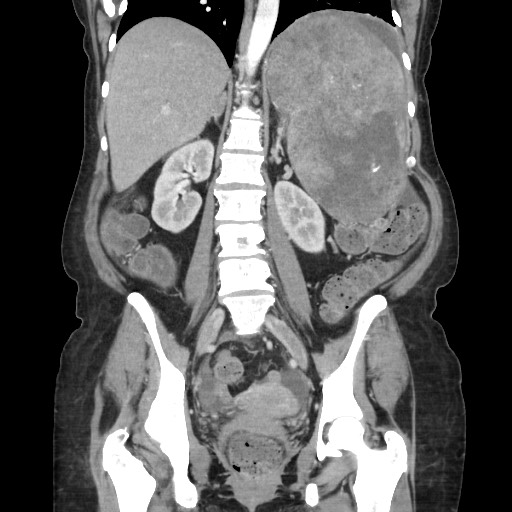Acinar cell carcinoma of the pancreas (Radiopaedia 75442-86669 Coronal C+ portal venous phase 80).jpg