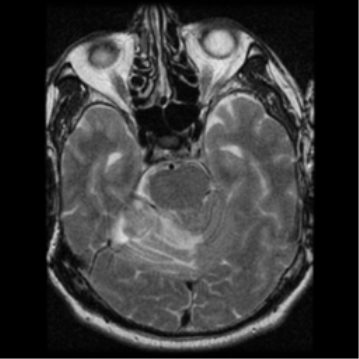 File:Acoustic schwannoma (Radiopaedia 39170-41387 Axial T2 12).png