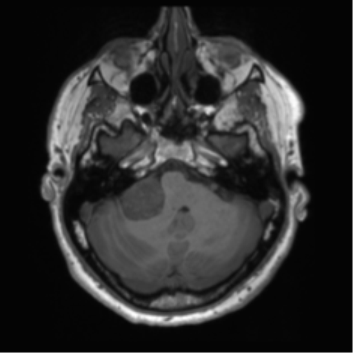 File:Acoustic schwannoma (Radiopaedia 50846-56358 Axial T1 19).png