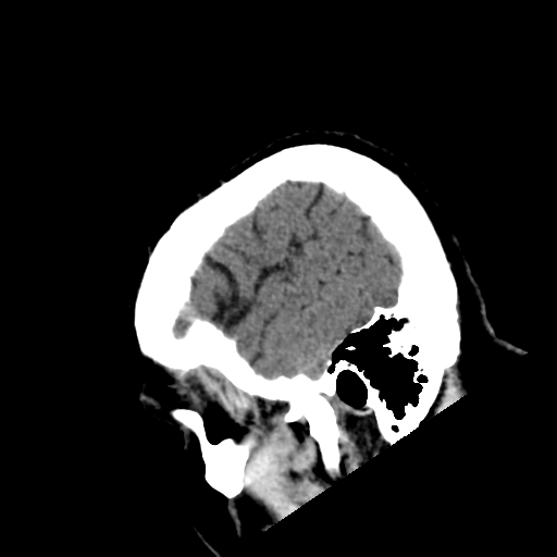 File:Acoustic schwannoma (Radiopaedia 55729-62280 Sagittal non-contrast 5).png
