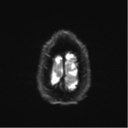 Acoustic schwannoma (Radiopaedia 55729-62281 E 27).png