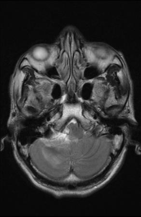 File:Acoustic schwannoma - probable (Radiopaedia 20386-20292 Axial T2 4).jpg