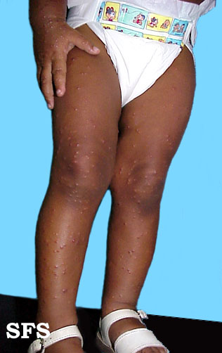 Acrodermatitis Infantile Papular (Dermatology Atlas 9).jpg