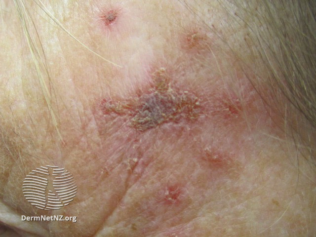 Actinic Keratoses affecting the face (DermNet NZ lesions-ak-face-248).jpg