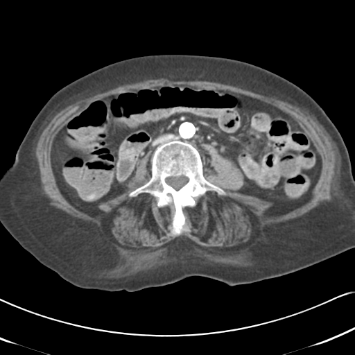 File:Active bleeding from duodenal ulcer with embolization (Radiopaedia 34216-35481 C 33).png