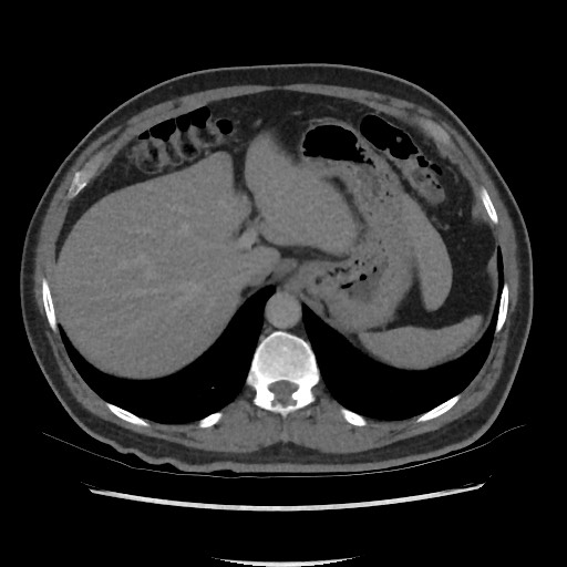 File:Active colonic bleed on CT (Radiopaedia 49765-55025 Axial C+ delayed 17).jpg