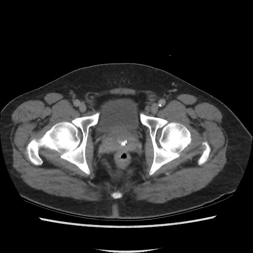 File:Active colonic bleed on CT (Radiopaedia 49765-55025 Axial C+ delayed 80).jpg