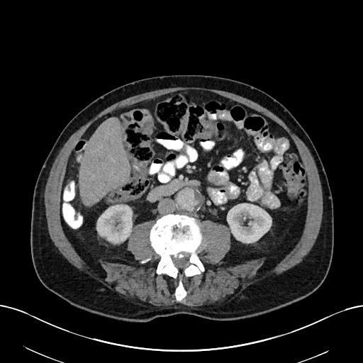 File:Active lower gastrointestinal bleeding - diverticular (Radiopaedia 61203-69106 Axial C+ portal venous phase 67).jpg